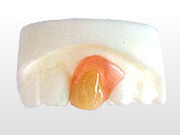 ミラクル義歯